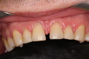 diastema