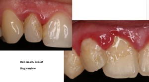 stan zapalny dziąseł