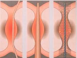 szczoteczki międzyzębowe