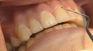 próchnica zębów stałych