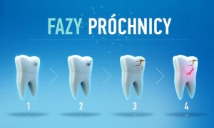 fazy próchnicy